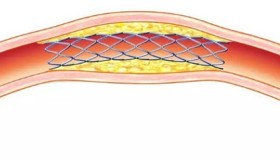 冠状动脉支架植入术