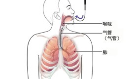 支气管镜