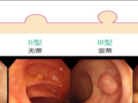 消化科 | 需要了解的结肠息肉那些事