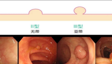 消化科 | 需要了解的结肠息肉那些事