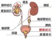 泌尿外科 | 泌尿系结石科普