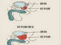 泌尿外科 | 关注男性健康——前列腺增生