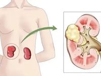 泌尿外科 | 肾癌科普知识