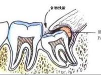 口腔科 | 阻生牙到底拔不拔？