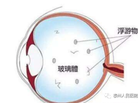 眼科 | 眼前“虫子”飞，到底为哪般？