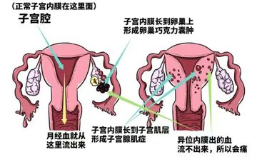 病理科||病理科普——子宫腺肌症